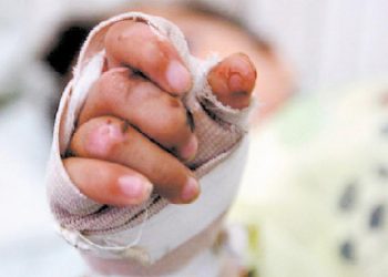 Dos nuevos quemados con pólvora en Ibagué 