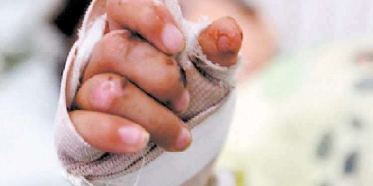 Dos nuevos quemados con pólvora en Ibagué 