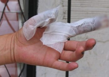 70 personas quemadas con pólvora en el Tolima