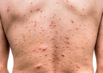 Primer caso de viruela del mono cerca a Colombia