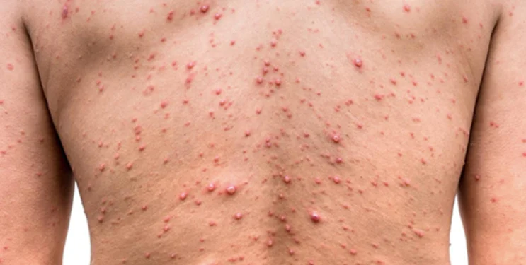 Primer caso de viruela del mono cerca a Colombia