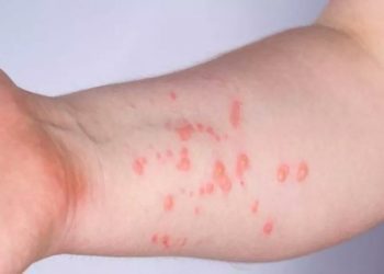 Van 20 casos por Viruela Símica en Ibagué