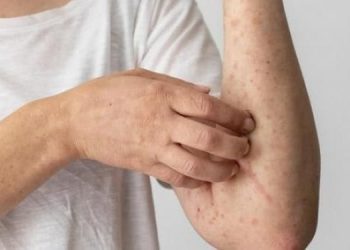 Van 58 casos de Viruela Símica en Ibagué