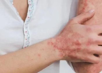 Sin nuevos casos de la Viruela Símica en las últimas semanas está Ibagué