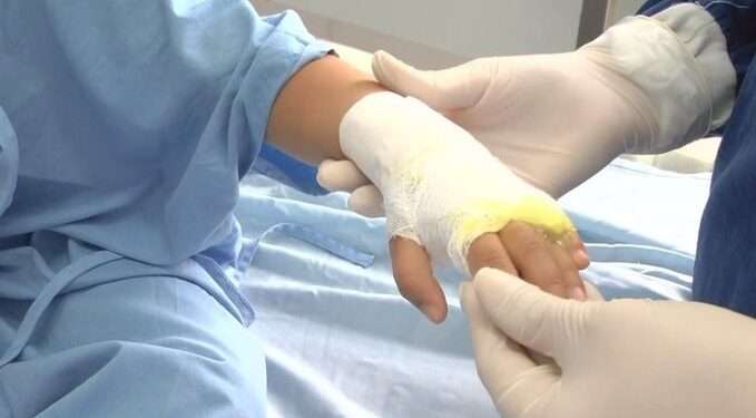 Preocupante aumento de quemados por pólvora en Ibagué durante las festividades