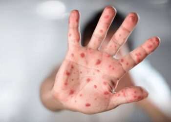 Ibagué entre las ciudades más afectadas por la viruela del mono