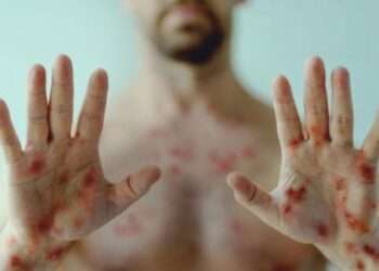 Ibagué sin casos de viruela símica, pero autoridades refuerzan vigilancia sanitaria