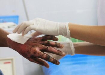 Ibagué registra cuatro casos de quemados por pólvora en temporada decembrina