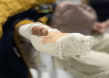 Aumentan los casos de quemados por pólvora en Ibagué: dos hombres heridos en Fin de Año